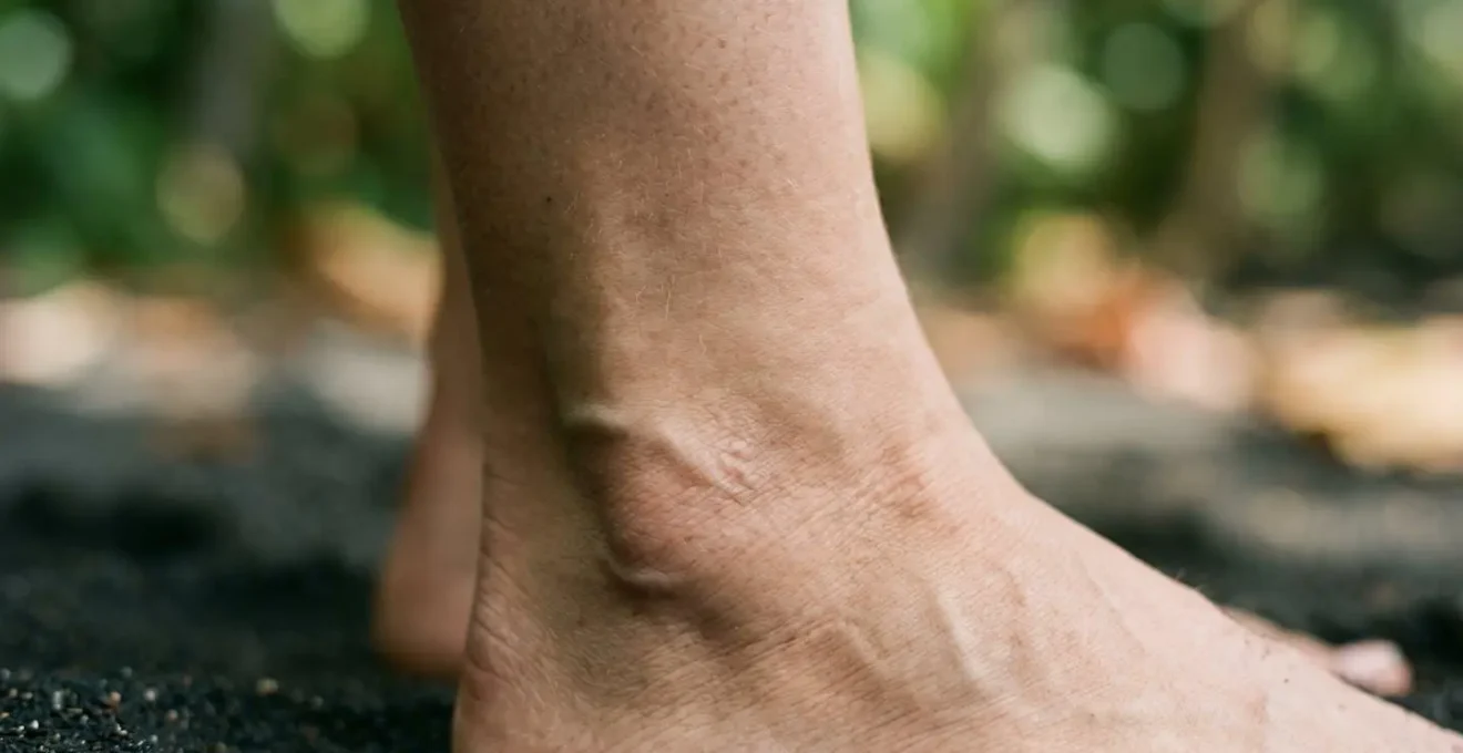 Gros plan sur chevilles et pieds gonflés en climat tropical illustrant l'œdème périphérique lié à la chaleur